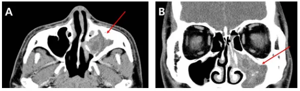 Figure 1. Pre-operative brain MRI. (A) T1-weighted image showing the lesion located to the left maxillary sinus is isointense with surrounding muscle tissue; (B) T2-weighted image showing a hyperintense lesion in the left maxillary sinus