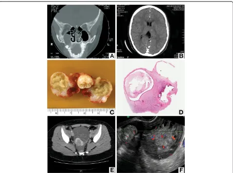 Figure 1 Imaging studies. (A) Computed tomography scan showing odontogenic keratocyst