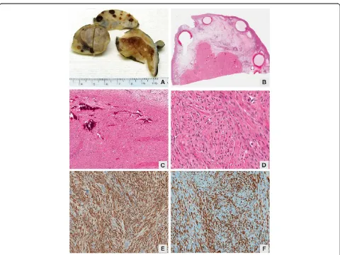 Figure 2 Examination of the gross specimen. (A) Gross image of ovarian fibroma. (B) Photomicrograph of ovarian fibroma