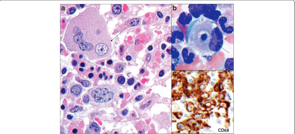 Figure 1 Bone marrow biopsy and aspirate showing hemophagocytosis and positive staining for CD68 marker for the presence ofmacrophages.