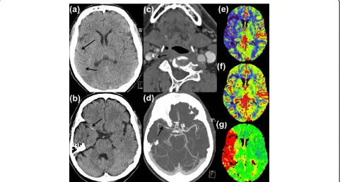 Figure 1 Early signs of ischemia in native cranial computed tomography scan with effacement of sulci and loss of the insular ribbon inComputed tomography perfusion imaging with a clear perfusion deficit (red area of time-to-peak(e)right middle cerebral art