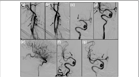 Figure 2 First angiogram of right internal carotid artery in oblique view demonstrates a high-grade stenosis with calcified andrarefication of the terminal branches of the right middle cerebral artery in the parieto-occipital regionsegment of right anterio