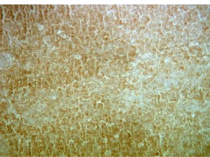 Figure 15. IHC(40x) CD20 Positivity in Hashimoto’s Thyroiditis  