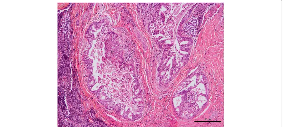 Figure 3 Photomicrograph of hematoxylin-and-eosin-stained section of mucoepidermoid carcinoma.