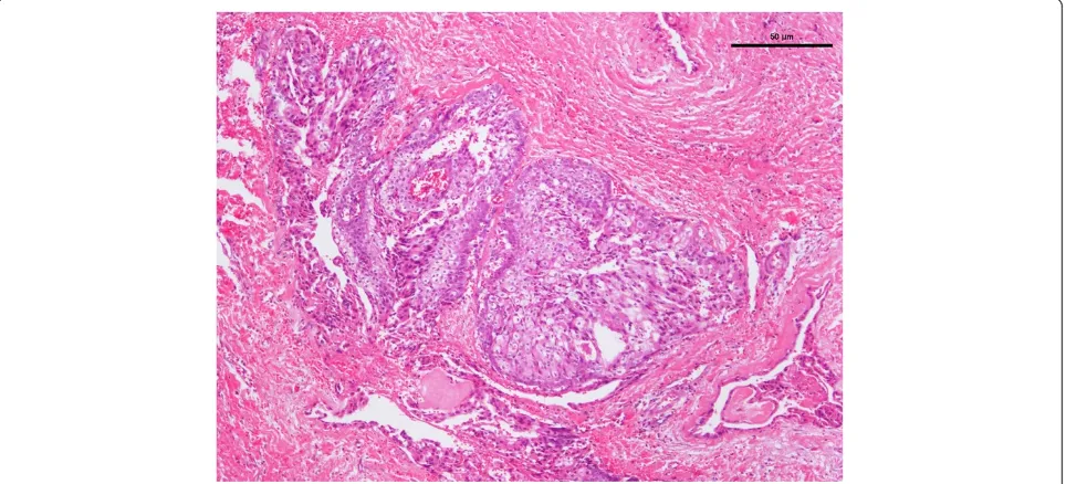 Figure 5 Photomicrograph of hematoxylin-and-eosin-stained section of mucoepidermoid carcinoma.