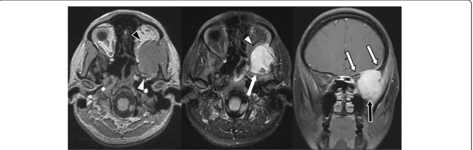 Table 1 Angiosarcoma of the brain in adults: case reports and series