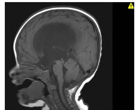 Figure 2 Sagittal T1-weighted magnetic resonance image fourweeks after the endoscopic third ventriculostomy