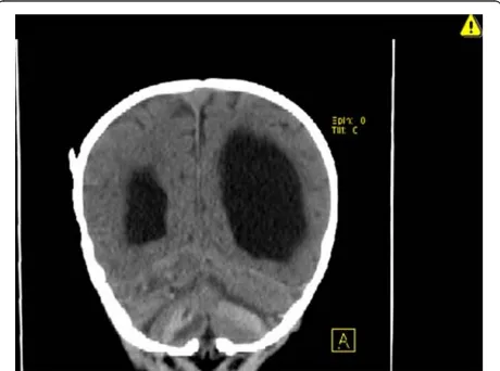 Figure 3 Sagittal computed tomography scan demonstratingthe extent of the subcortical and intraparenchymal cerebellarhemorrhage