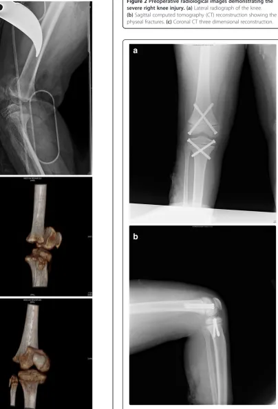 Figure 2 Preoperative radiological images demonstrating thesevere right knee injury. (a) Lateral radiograph of the knee.(b) Sagittal computed tomography (CT) reconstruction showing thephyseal fractures