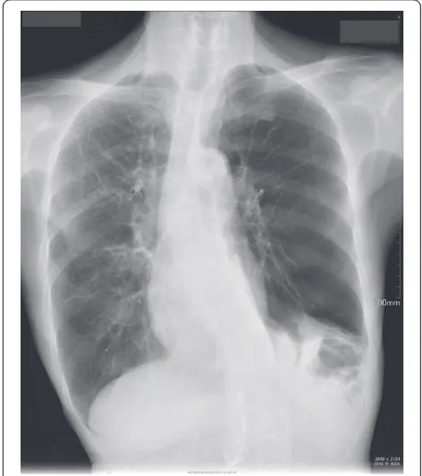Figure 2 Chest roentgenography on admission showingmultiple bullae and bilateral emphysema with leftdiaphragmatic hernia.