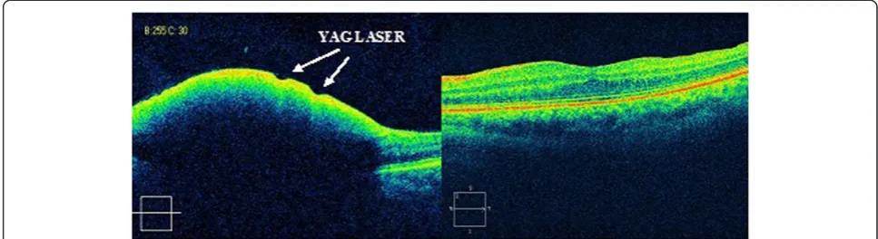 Figure 5 Optical coherence tomography prior to and after vitrectomy in a patient previously treated with Nd-YAG laser,without success (case 2).
