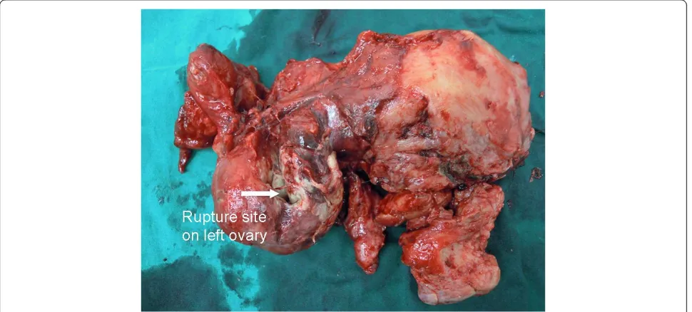 Figure 1 During the operation, a ruptured left tubo-ovarian abscess is found.