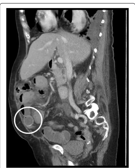 Figure 2 Sagittal computed tomography image shows acalculus in the distal small bowel with proximal dilatation.