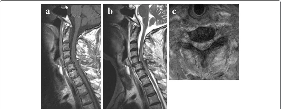 Figure 1 Plain X-ray film images showing slight spondylolisthesis of C5 immediately after a traffic accident