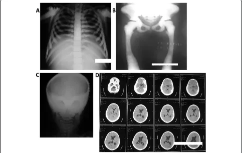 Figure 1 X-rays and computed tomography scan image of the patient showing bone thickening.homogenously sclerotic skull bones encroaching on both optic foramens, and mild dilatation of the lateral and third ventricle with normalhomogenous sclerotic skull bo
