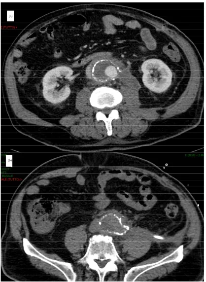 Figure 1. CT scan at 21 postoperative days revealed a left psoas abscess. 