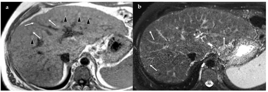 Figure 3 Unenhanced MR imaging in a in a 61-year-old man with alcohol-related cirrhosis