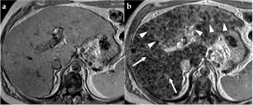 Figure 4 Advanced fibrosis and infiltrative HCC in a 46-year-old man with HCV-related 