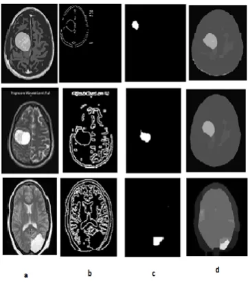 Fig.2: Sample MRI Images and their outputs using LBP and Morphological operations. 