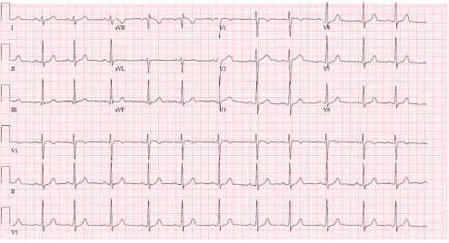 FIGURE 2Baseline, afebrile electrocardiogram showing normal sinus rhythm at 71 beats per minute