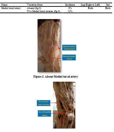 Figure 3. Absent Medial tarsal artery  