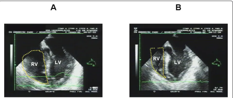 Table 1 End-diastolic size of the left ventricle accordingto the ejection fraction