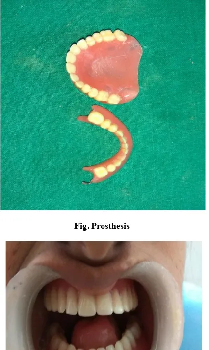 Fig. Dentures in mouth 