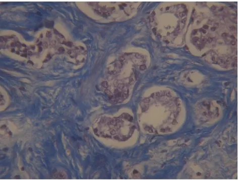 Table 1. Distribution of the stage of the disease in 70 patients with prostatic carcinoma  