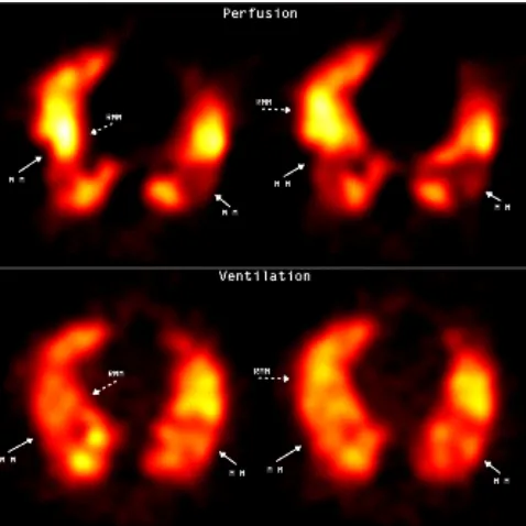Figure 2.7.  DTPA aerosol. Areas of absent perfusion in both lower lobes are well ventilated, constituting mismatching defects