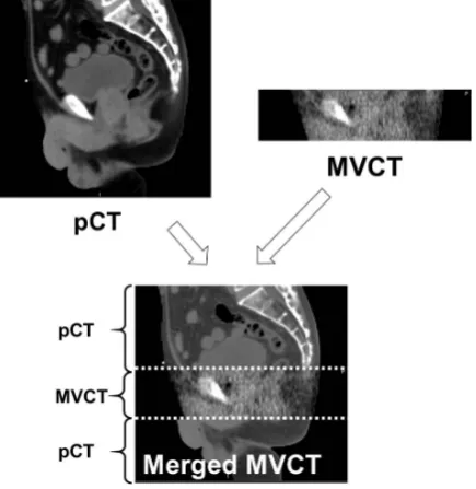Figure 3 demonstrates the workflow of the deformable dose accumulation in  