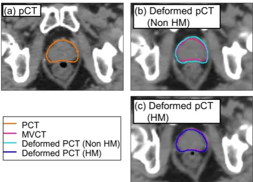 Figure 4. A typical case of improving the accuracy of deformation using HM method for CTV