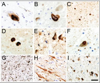 Figure 2-2. Histological characterization of patients with LRRK2 mutations. (A, B) Staining for α-synuclein in the SNpc of patient D demonstrating a dopaminergic neuron with multiple LBs (A) or a typical spheroid (B)