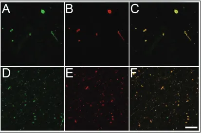 Figure 2-3. Double-labeling Immunofluorescence Analysis of α-Synuclein Phosphorylated at S129 in Pathological Inclusions of Patients with LRRK2 Mutations