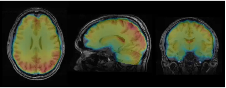 Figure 2.5:BOLD fMRI may be used to infer functional activation. Here, the BOLDsignal is displayed as a color overlay on an anatomical MR image in an individual subject.