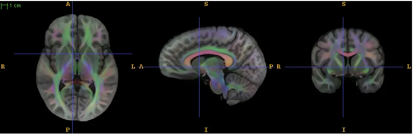 Figure 3.2: Triplanar view of the combined T1 and DTI template provided by SyNMN.The directionally-encoded color map obtained from the principal direction of diﬀusionin the DTI data provides an overlay to the T1 data.