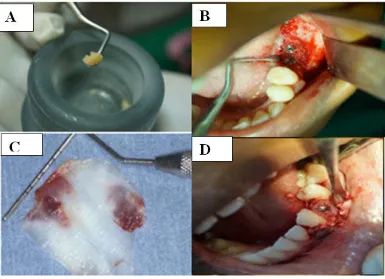 Fig. 1. Placing PRP(A,B) and PRF(C,D) in the Peri implant defect area  
