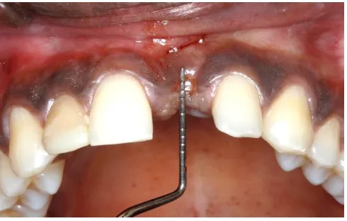 Fig. 27 Preserved socket Mesio-distal measurement 