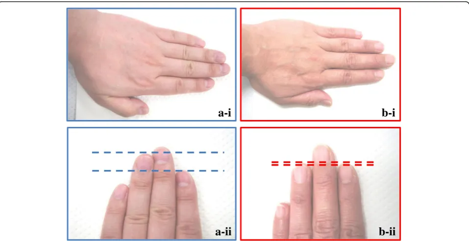 Fig. 4 Differences in phalangeal length (ring finger–index finger) in men and women