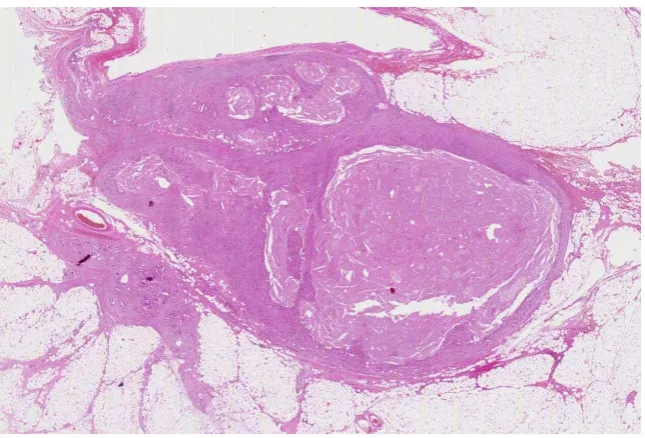 Figure 2. Papillary renal cell carcinoma type 1, characterised by tubulopapillary architec-ture with admixed foamy histiocytes in the papillary cores (HE staining, 10×)