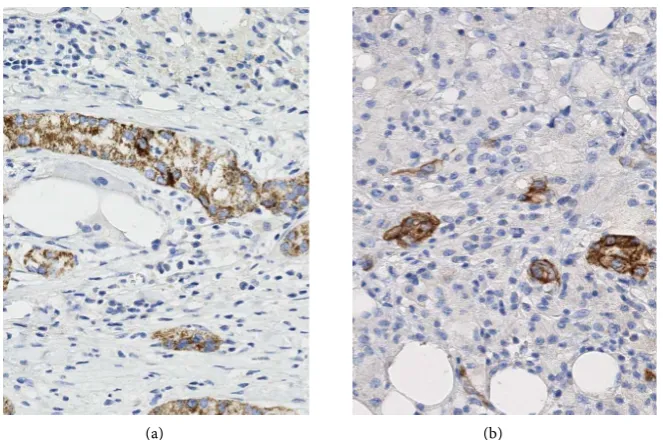 Figure 4. Peri-renal fat overlying the tumor showing papillary renal cell carcinoma seed-ing along the previous percutaneous biopsy tract (HE staining, 20×)