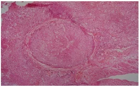 Fig. 4. Section of the adrenal showing cortical hemorrhage  [H and E, x400 ]  