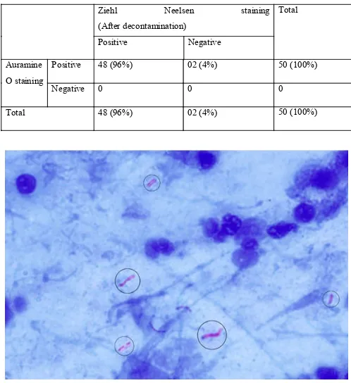 Table 3: Comparison of ZN staining and AO staining after sputum decontamination. 