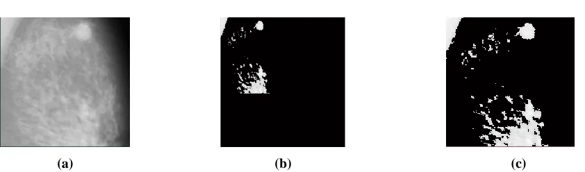 Figure 5. Original mammographic image & its segmented images using (b) Threshold,  (c) K-means clustering 