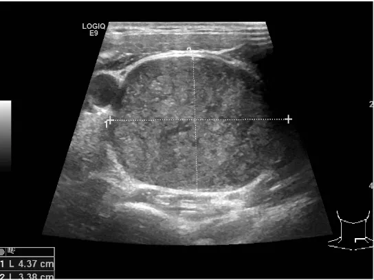 Figure 1. Transverse ultrasound image. A well circumscribed hypoechoic image, which is intrinsic with the left thyroid lobe