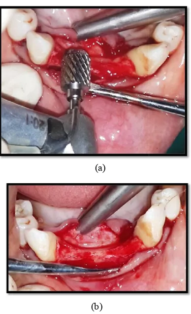 Figure 9. Implant placed after ridge expansionImplant placed after ridge expansion  