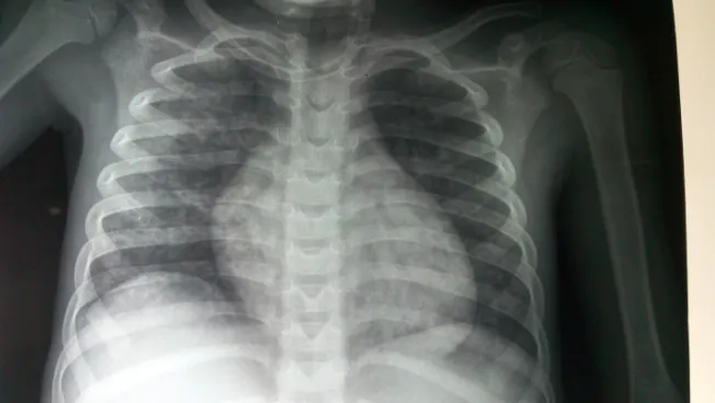 Figure 1. Frontal chest radiograph of case No. 1, bilateral lesions predominantly on the right