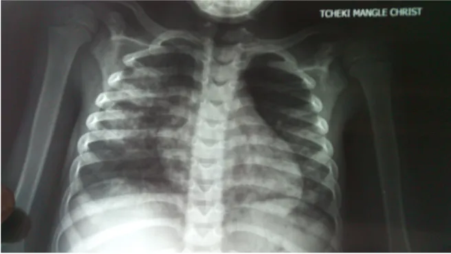 Figure 2. Frontal chest radiograph of case No. 2, bilateral lesions predominantly on the right