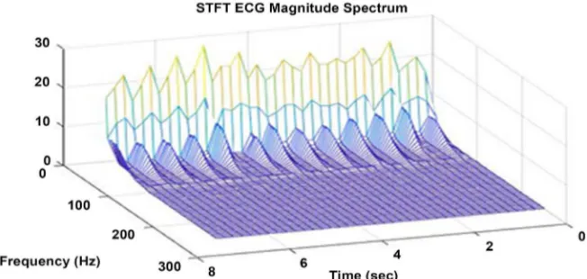 Figure 11. Arrhythmia ECG signal with 10 sec time duration. 