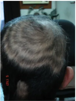 Figure 1. Concentric polycyclic hair regrowth, in a 25 years old male, on the parietal & temporal areas
