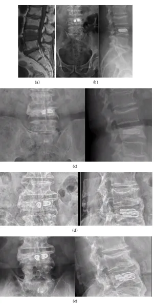 Figure 3. (a) Magnetic resonance image of patient 3 before surgery showing progressively increasing abundant bony callus formation at the L4 vertebral body marrow edema at the L4 vertebral body